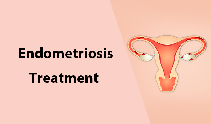 endometriosis treatment